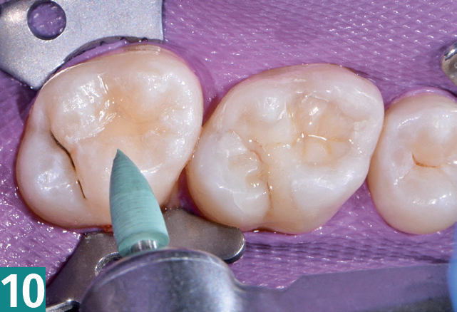 Реставрация DMG Constic - этап 10